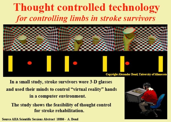 Infographic for stroke study